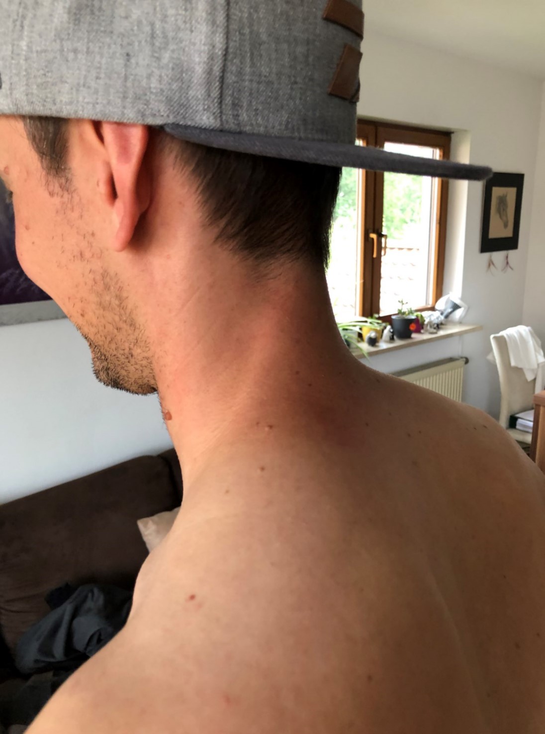 Nacken vor Behandlung