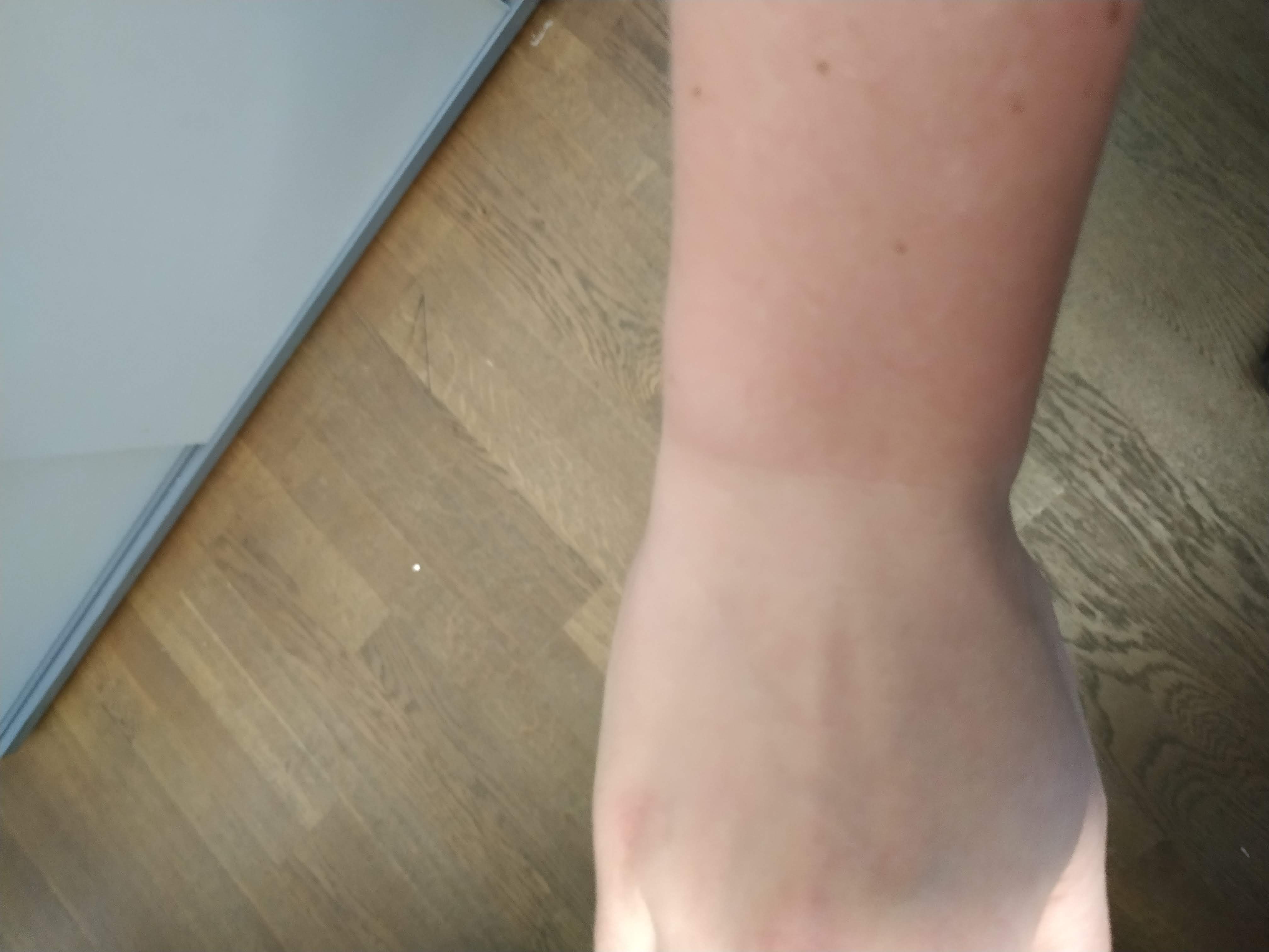 sonnenbrand