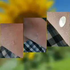 Die heilende Wirkung der Mückenpflaster ist meiner Meinung nach hervorragend und dafür gebe ich dem Produkt 5 Sterne.