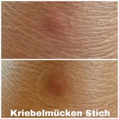 Der Stich heilt 3x so schnell, wie ich es sonst bei meinen anderen Behandlungsmethoden beobachten konnte.