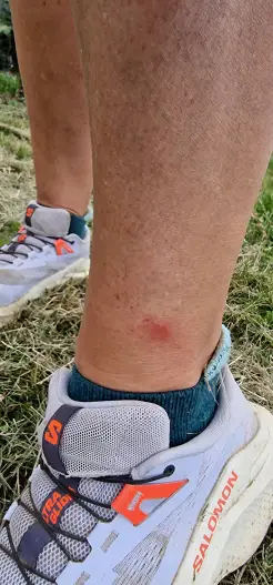 Keine Behandlung mit dem Relags Mückenstichpflaster
